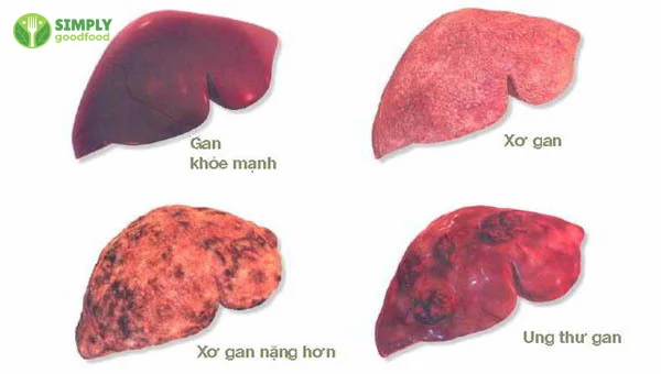 Cơm nguội và thực phẩm qua đêm có thể gây ung thư gan, cần cẩn trọng.