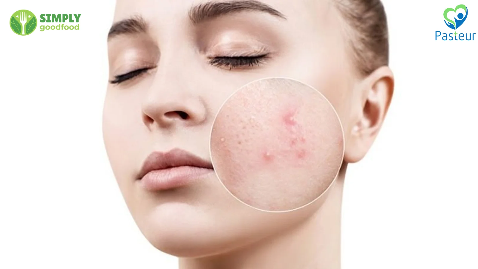 Cà chua giúp trị mụn hiệu quả, dưỡng da khỏe đẹp tự nhiên